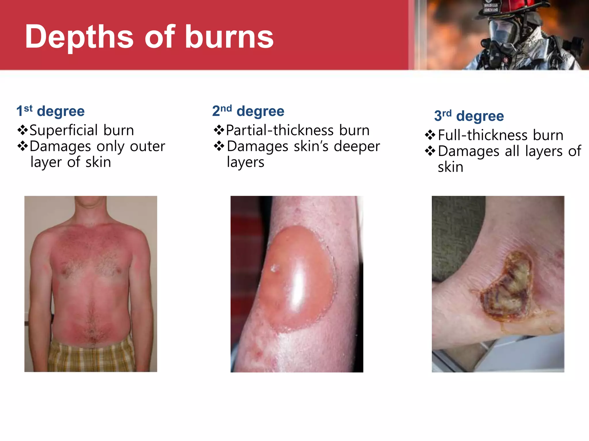 Depths of burns
1st degree
Superficial burn
Damages only outer
layer of skin
2nd degree
Partial-thickness burn
Damages skin’s deeper
layers
3rd degree
Full-thickness burn
Damages all layers of
skin
 