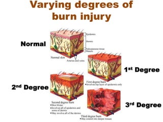 Normal
1st Degree
2nd Degree
3rd Degree
Varying degrees of
burn injury
 