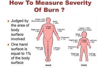 How To Measure Severity
Of Burn ?
Judged by
the area of
body
surface
involved
One hand
surface is
equal to 1%
of the body
surface
 
