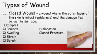 Types of Wound
1. Closed Wound – a wound where the outer layer of
the skin is intact (epidermis) and the damage lies
below the surface.
Examples
❑ Bruises Dislocation
❑ Swelling Closed Fracture
❑ Strain
❑ Sprain
 