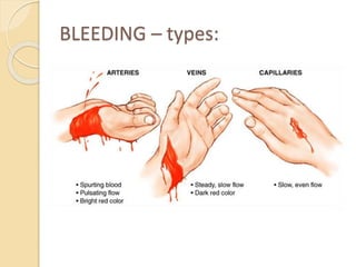 BLEEDING – types:
 