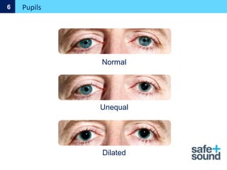 Pupils
6
Normal
Unequal
Dilated
 