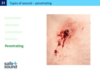 Types of wound – penetrating
31
Contusion
Abrasion
Laceration
Incision
Penetrating
 