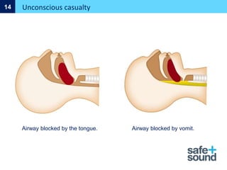 Unconscious casualty
14
Airway blocked by the tongue. Airway blocked by vomit.
 