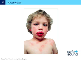 Picture: Many Thanks to the Anaphylaxis Campaign.
Anaphylaxis
17
 