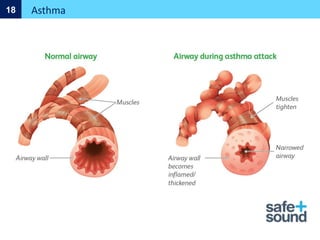 Asthma
18
 