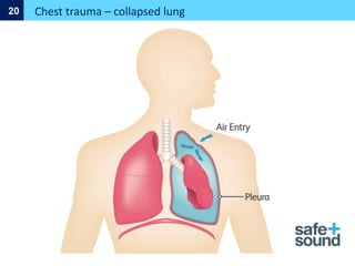 Chest trauma – collapsed lung
20
 