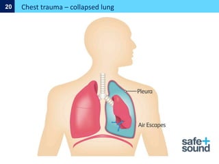 Chest trauma – collapsed lung
20
 
