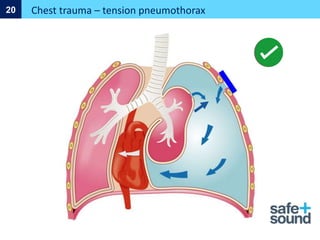 Chest trauma – tension pneumothorax
20
 