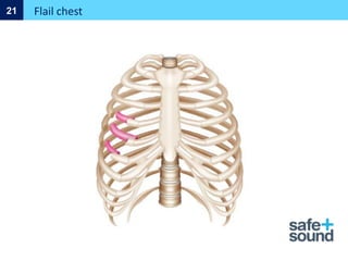 Flail chest
21
 