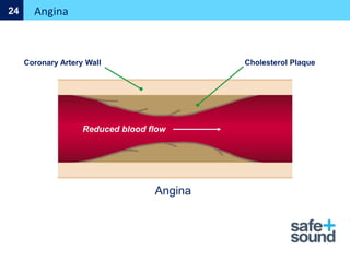 Cholesterol Plaque
Coronary Artery Wall
Reduced blood flow
Angina
Angina
24
 