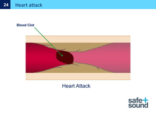 Heart Attack
Heart attack
24
Blood Clot
 