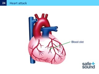 Heart attack
24
Blood clot
 