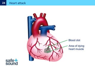 Area of dying
heart muscle
Heart attack
24
Blood clot
 