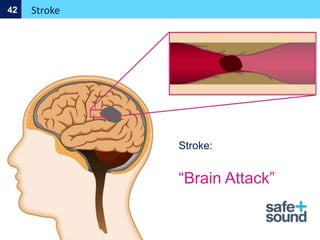 Stroke
42
Stroke:
“Brain Attack”
 