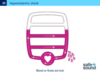 Hypovolaemic shock
26
Blood or fluids are lost
 