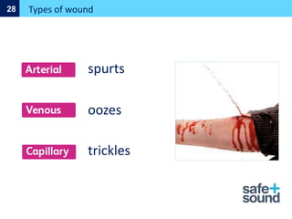 Types of wound
28
spurts
oozes
trickles
 