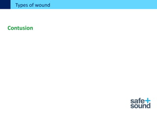 Types of wound
Contusion
 