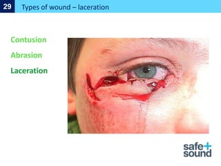 Types of wound – laceration
29
Contusion
Abrasion
Laceration
 