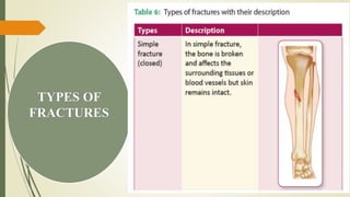TYPES OF
FRACTURES
 