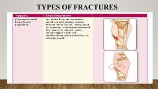 TYPES OF FRACTURES
 