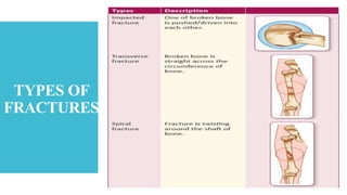 TYPES OF
FRACTURES
 