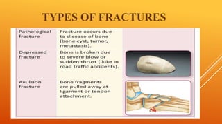 TYPES OF FRACTURES
 