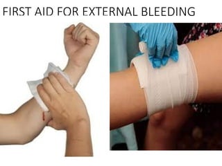 FIRST AID FOR EXTERNAL BLEEDING
 