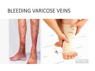 BLEEDING VARICOSE VEINS
 
