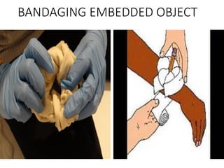 BANDAGING EMBEDDED OBJECT
 