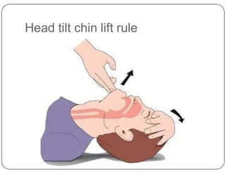 Head tilt chin lift rule
 