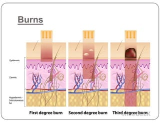 Burns
 