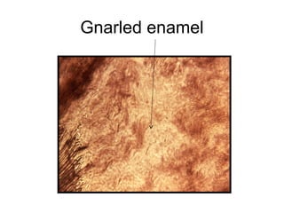 Gnarled enamel
 