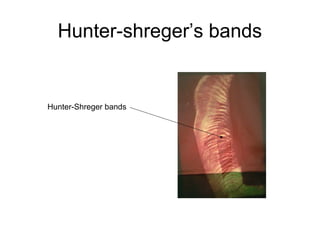 Hunter-shreger’s bands
Hunter-Shreger bands
 