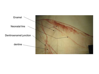 Enamel
Neonatal line
Dentinoenamel junction
dentine
 