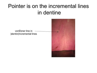 Pointer is on the incremental lines
in dentine
vonEbner line in
dentin(Incremental lines(
 