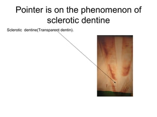 Pointer is on the phenomenon of
sclerotic dentine
Sclerotic dentine(Transparent dentin(.
 