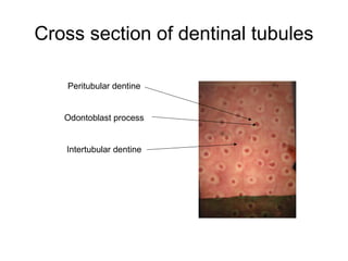 Cross section of dentinal tubules
Peritubular dentine
Odontoblast process
Intertubular dentine
 