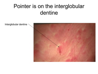 Pointer is on the interglobular
dentine
Interglobular dentine
 