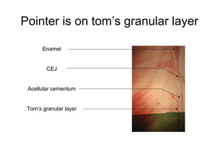 Pointer is on tom’s granular layer
Enamel
CEJ
Acellular cementum
Tom’s granular layer
 
