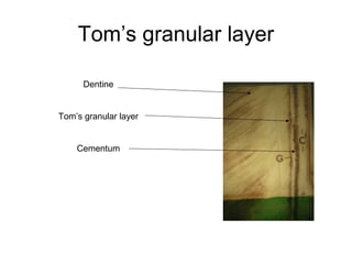 Tom’s granular layer
Dentine
Tom’s granular layer
Cementum
 