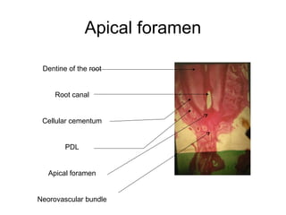 Apical foramen
Dentine of the root
Root canal
Cellular cementum
PDL
Apical foramen
Neorovascular bundle
 
