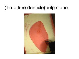 True free denticle(pulp stone(
 