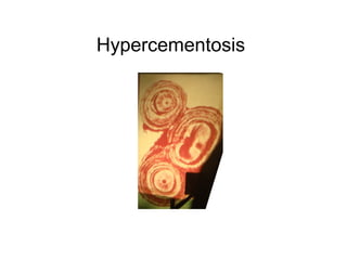 Hypercementosis
 
