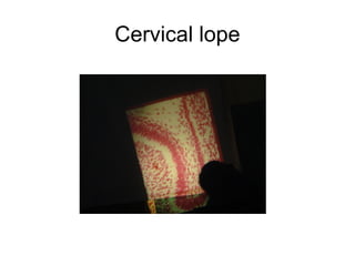 Cervical lope
 
