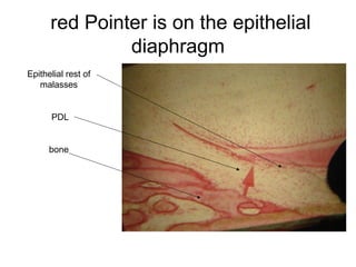 red Pointer is on the epithelial
diaphragm
Epithelial rest of
malasses
PDL
bone
 