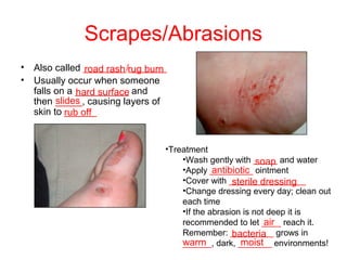Scrapes/Abrasions
• Also called ________/_______
• Usually occur when someone
falls on a __________ and
then _____, causing layers of
skin to ______
•Treatment
•Wash gently with _____ and water
•Apply _________ ointment
•Cover with ________________
•Change dressing every day; clean out
each time
•If the abrasion is not deep it is
recommended to let ____ reach it.
Remember: _________ grows in
______, dark, _______ environments!
road rash rug burn
hard surface
slides
rub off
soap
antibiotic
sterile dressing
air
bacteria
warm moist
 