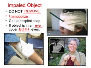 Impaled Object
• DO NOT _________
• I__________
• Get to hospital asap
• If object is in an ____,
cover ______ eyes.
REMOVE
mmobolize
eye
BOTH
 