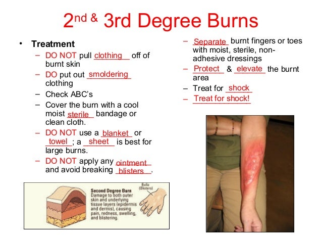 First Degree Burns Treatment First Degree Burns Treatment