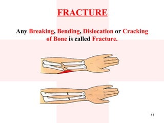 FRACTURE
Any Breaking, Bending, Dislocation or Cracking
          of Bone is called Fracture.




                                                 11
 
